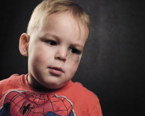 Boy with bruised eye.