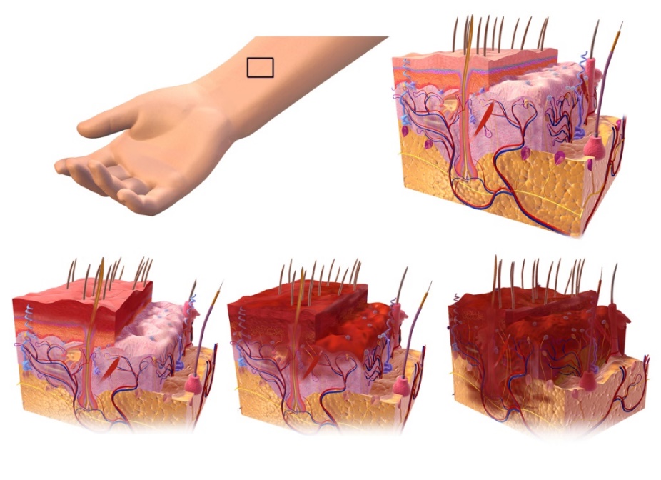 This image shows first, second, and third degree burns.